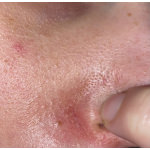 Becalm Lipbecalm Lip Balm για Σκασμένα Χείλη 10ml - Image 2